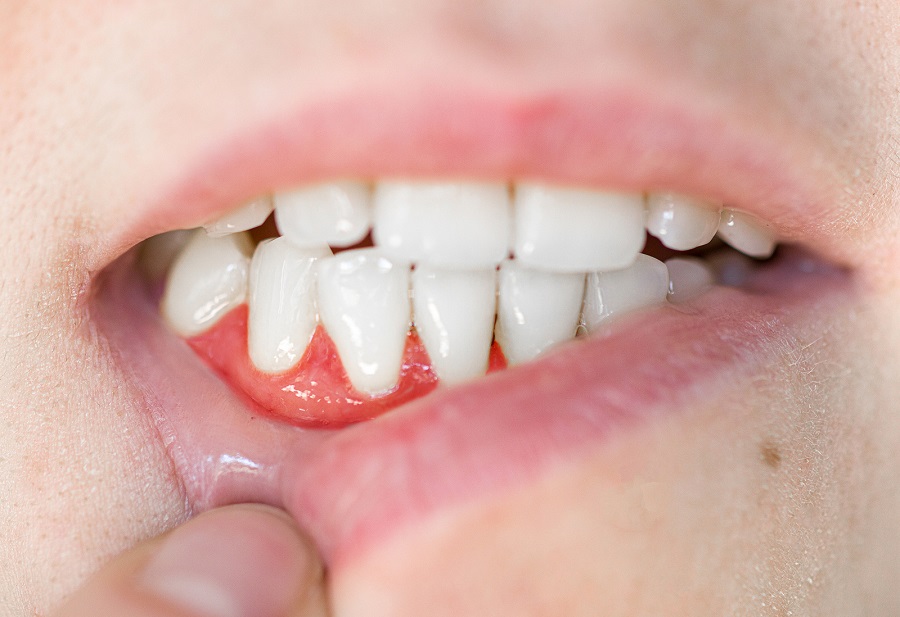 Is There a Link Between Gum Disease and Diabetes?