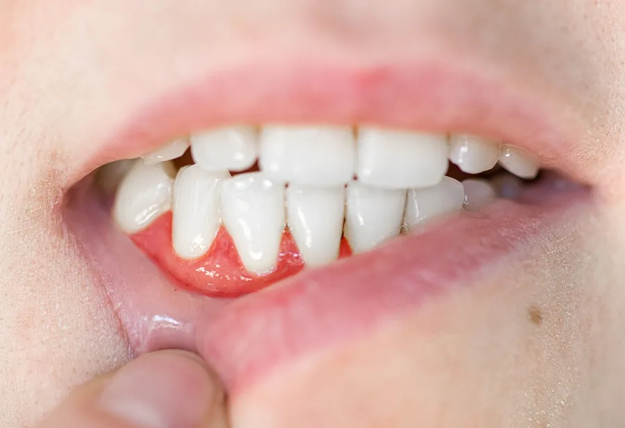 Is There a Link Between Gum Disease and Diabetes?