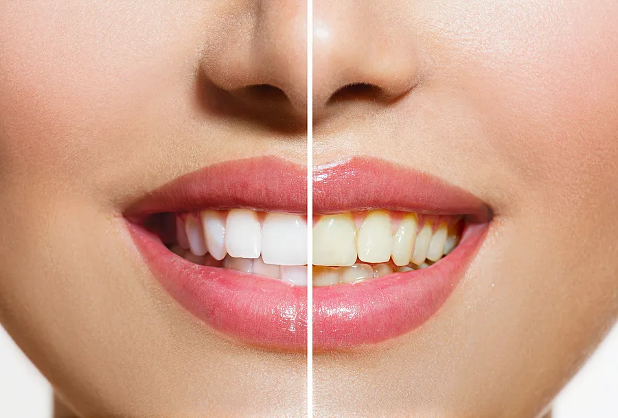 A Brighter Smile: The Benefits of Teeth Whitening in Kenmore, WA
