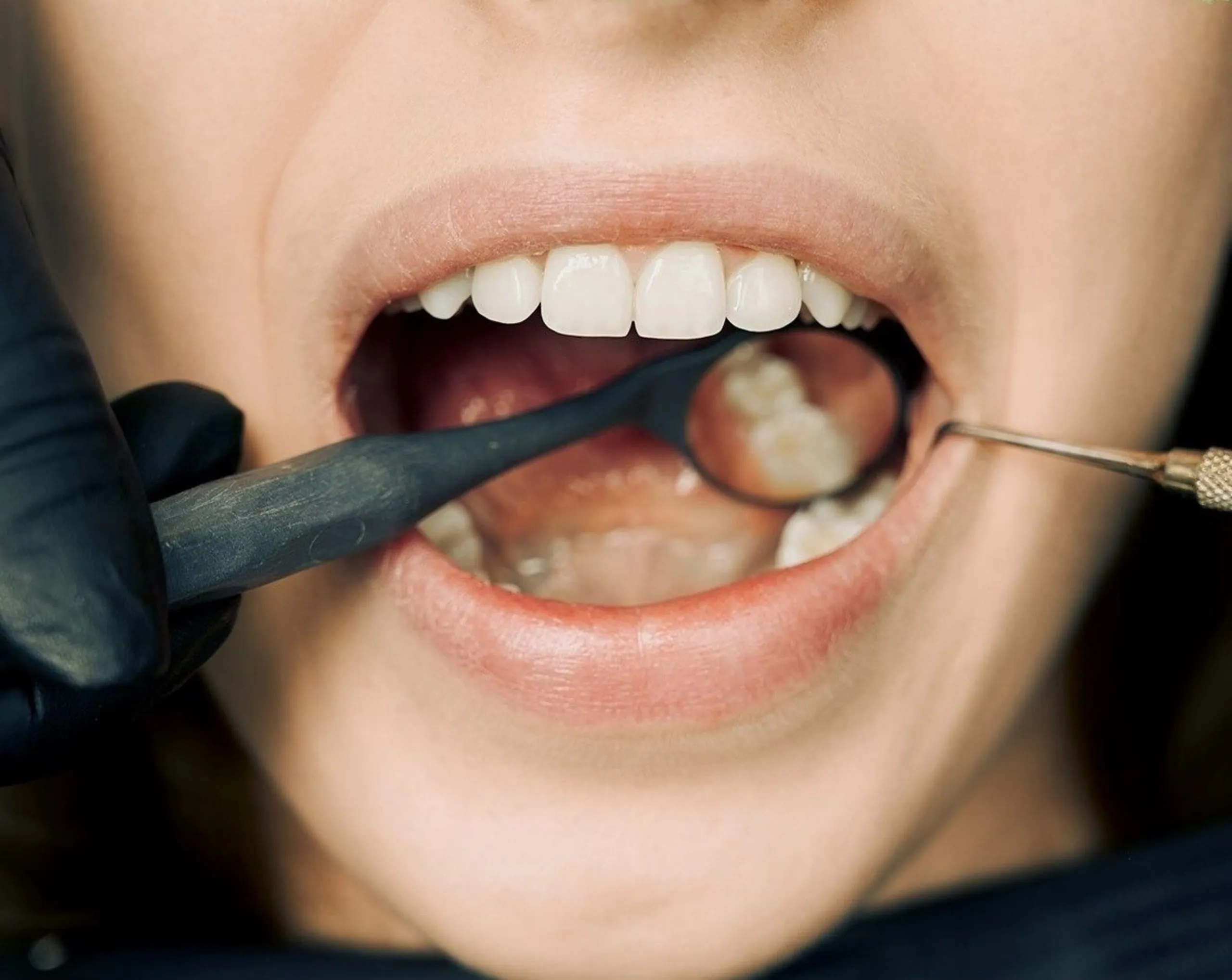 The Tooth-Colored Filling Procedure